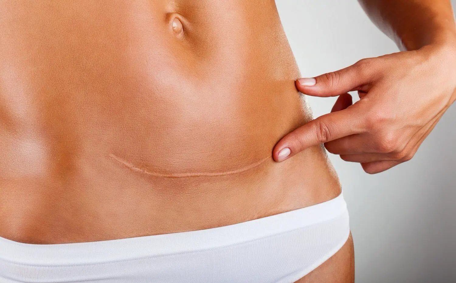Picture of a woman's stomach showing a long scar